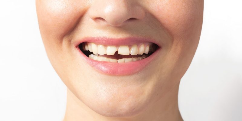 2026 Kırık Diş Tedavisi Fiyatları Hangi İşlem, Kaç TL